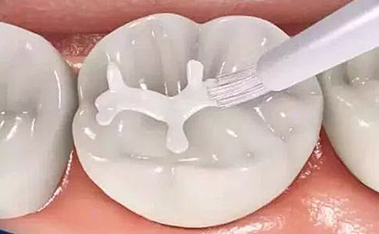 牙齒涂氟
